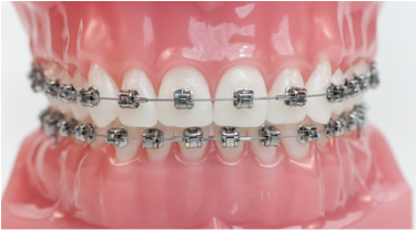 model of metal braces