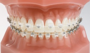 Orthodontic-ceramic-braces