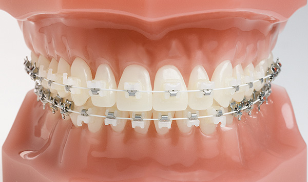 model of ceramic braces