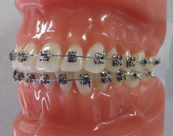 model of self ligating braces