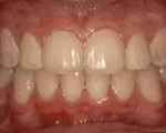 crowding-of-the-teeth-after