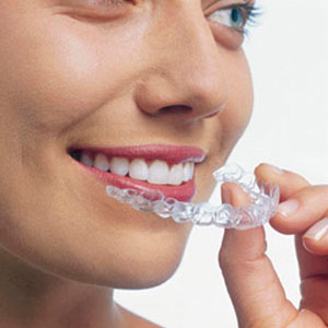 model of invisalign