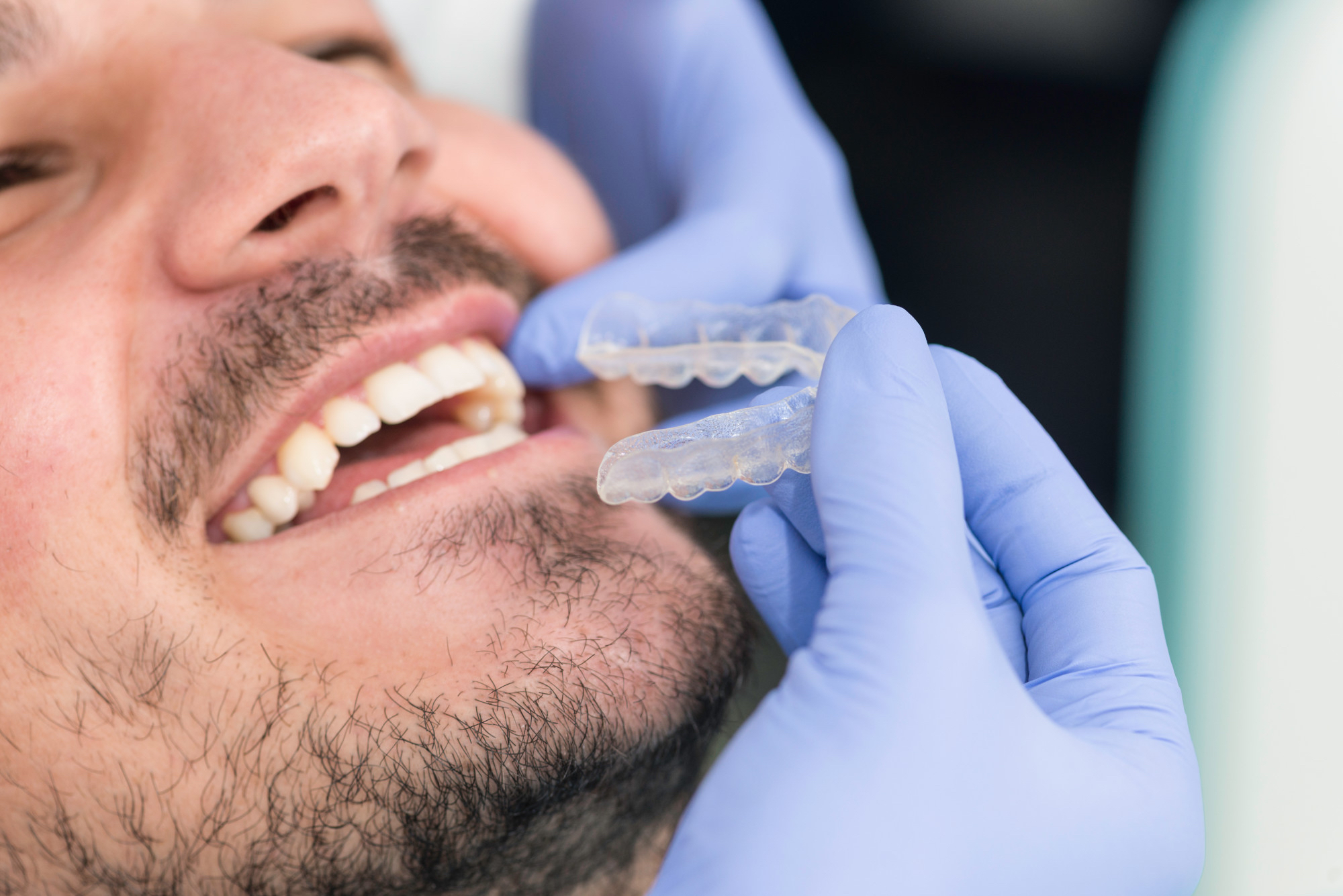 5 Things to Know About Getting Braces as an Adult