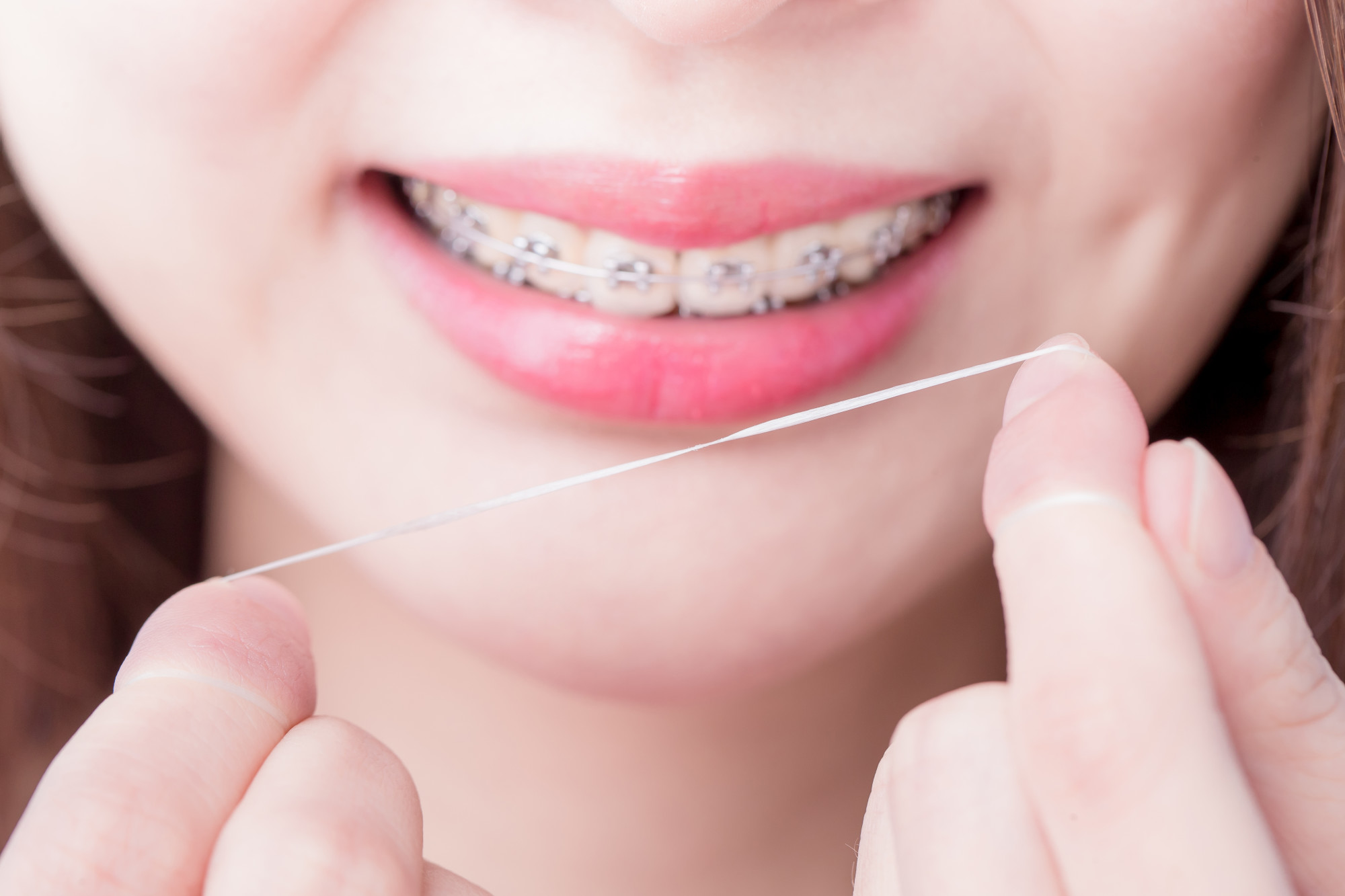 How to Floss With Braces: 5 Helpful Tips