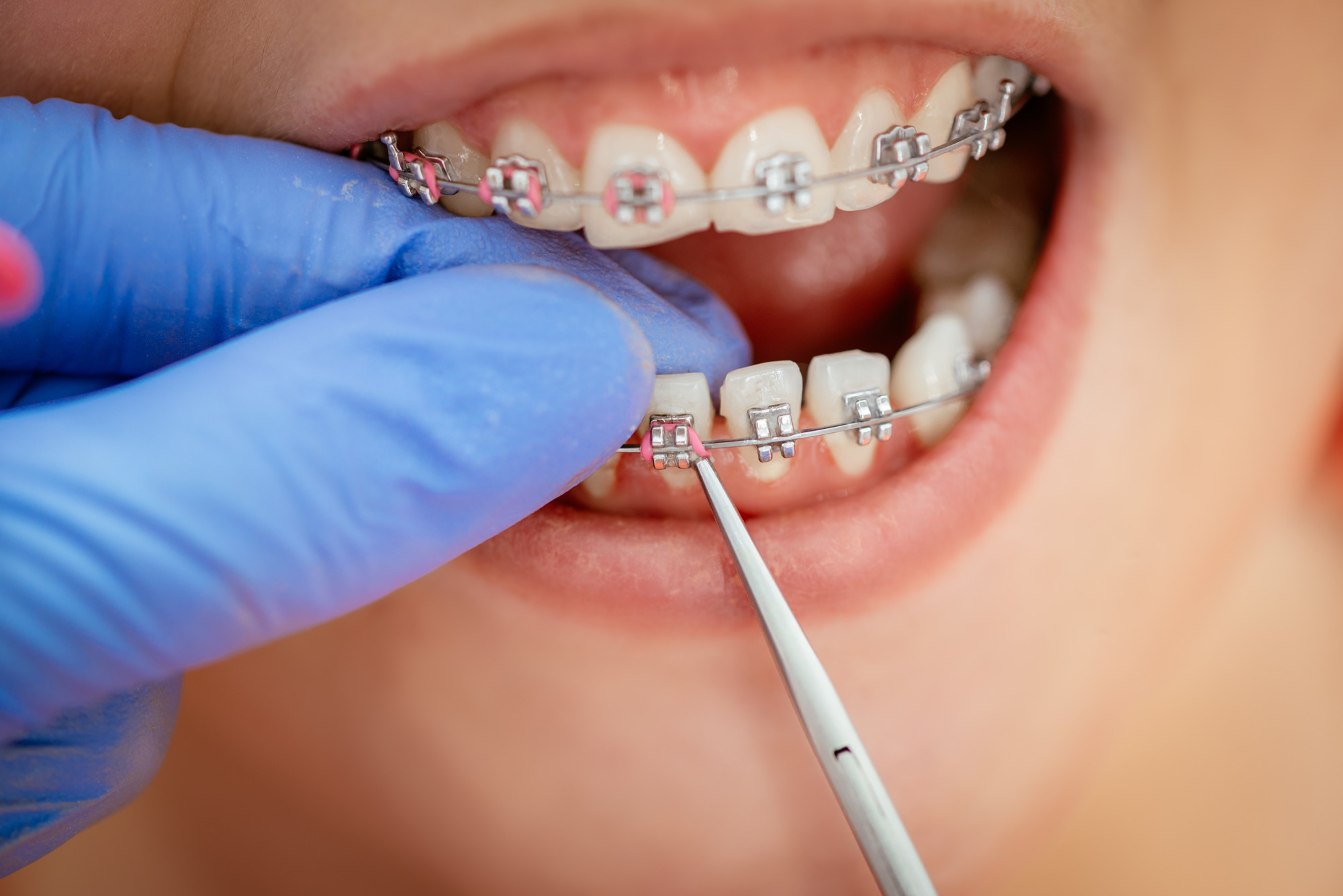 Broken Braces Bracket: This Is What You Need to Do
