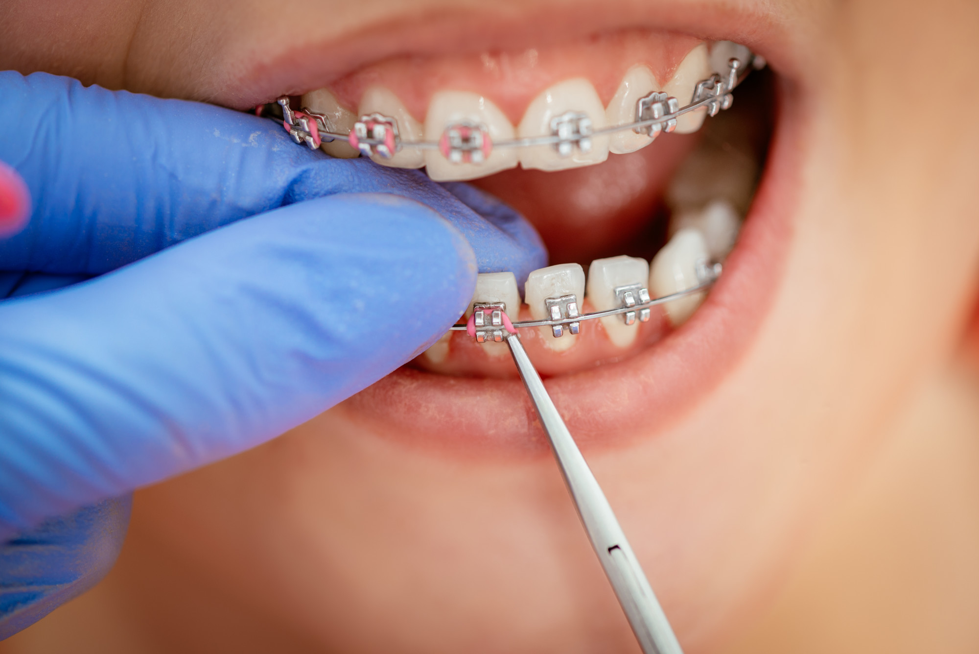 Help! My braces are broken. - Mehta Orthodontics