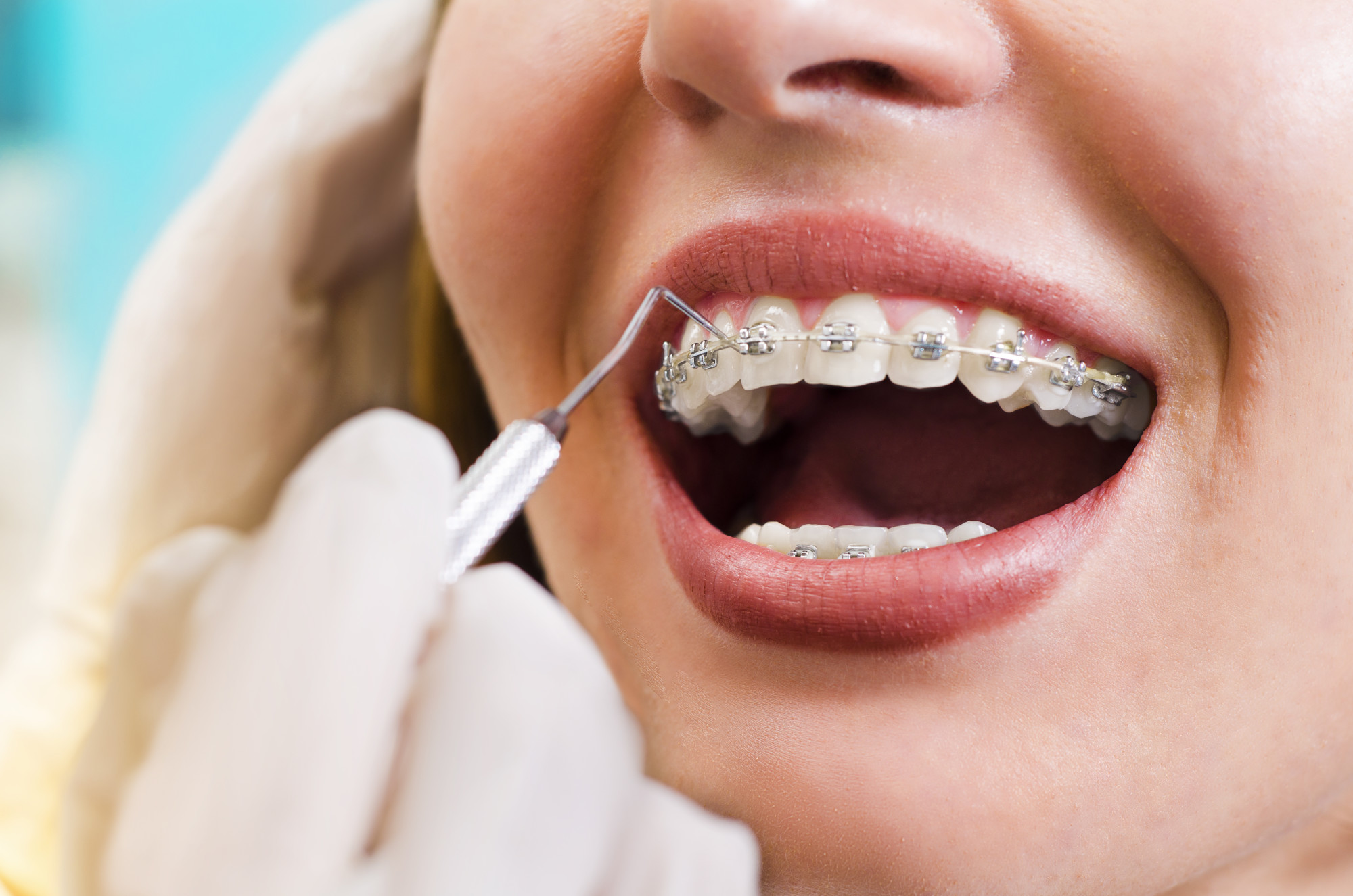 5 Surprising Health Benefits of Braces