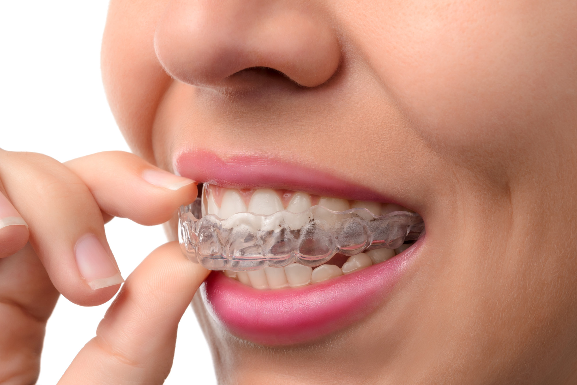 What’s the Difference Between Invisalign and Braces?