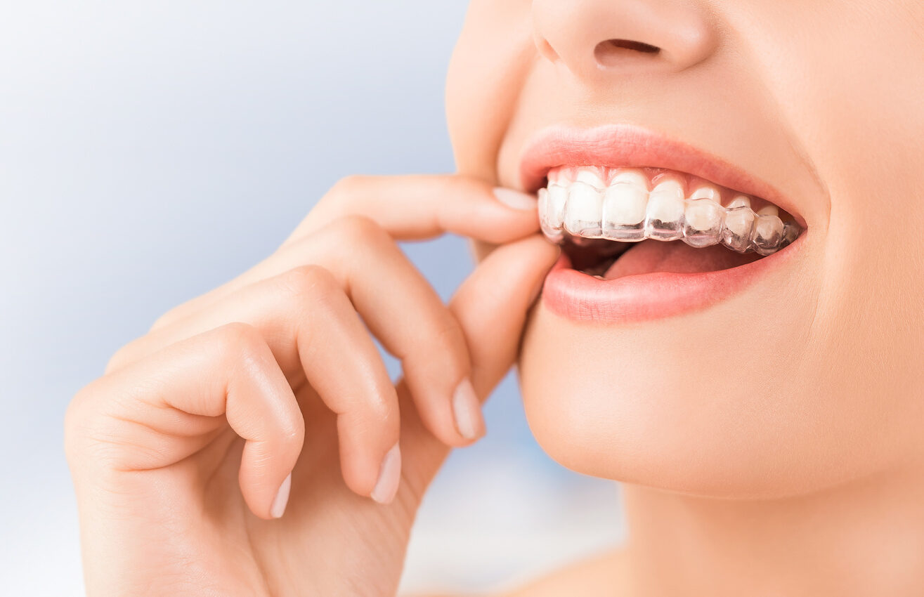 5 Incredible Benefits of Invisalign