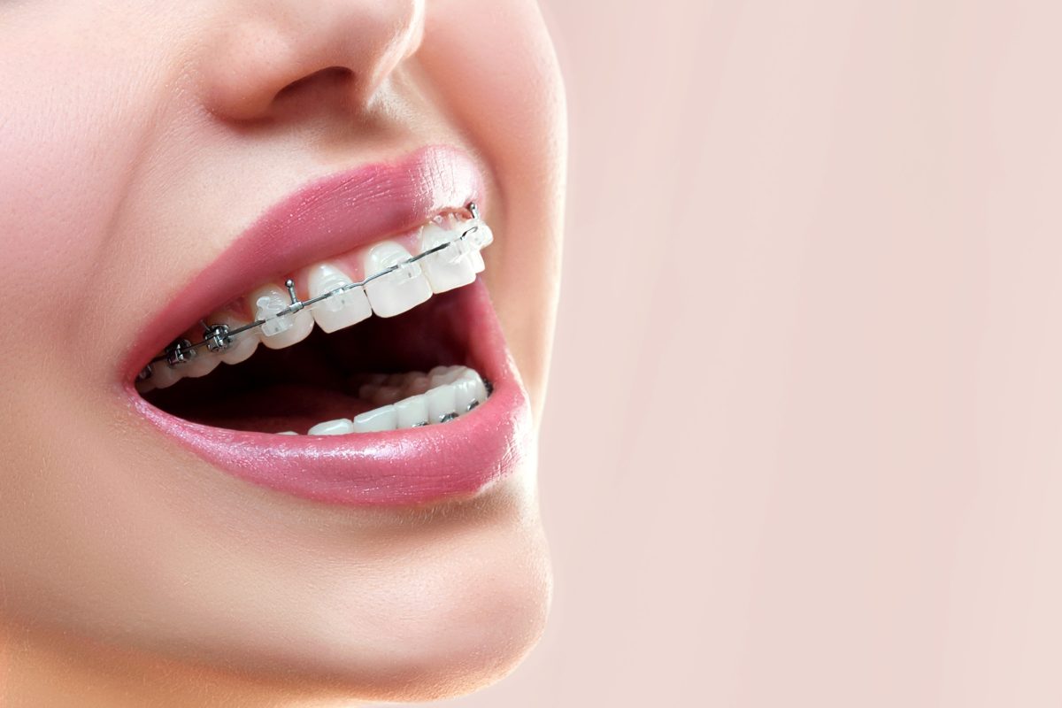 5 Benefits From Braces for Adults