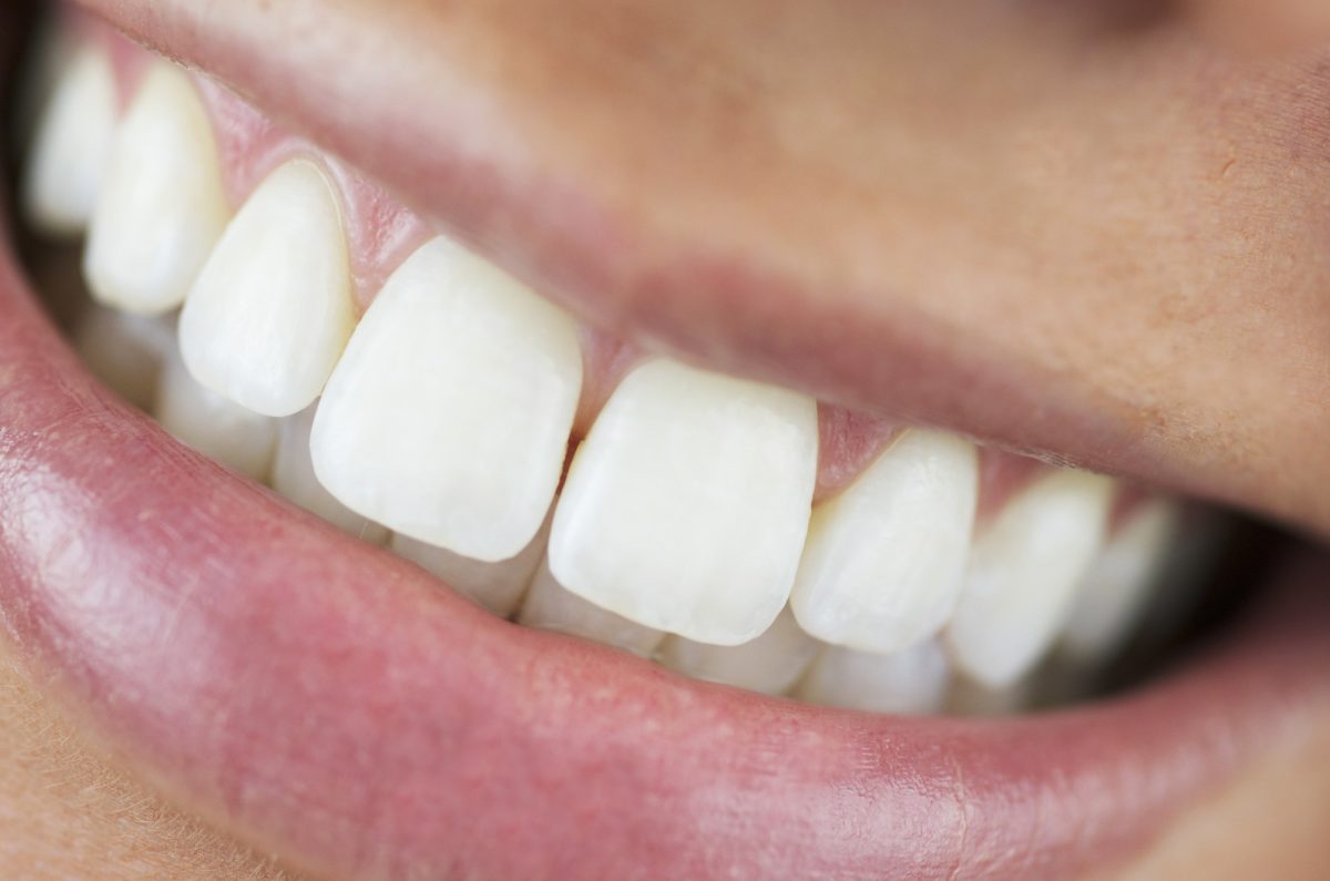 What Is an Overbite and How Can Braces Help?