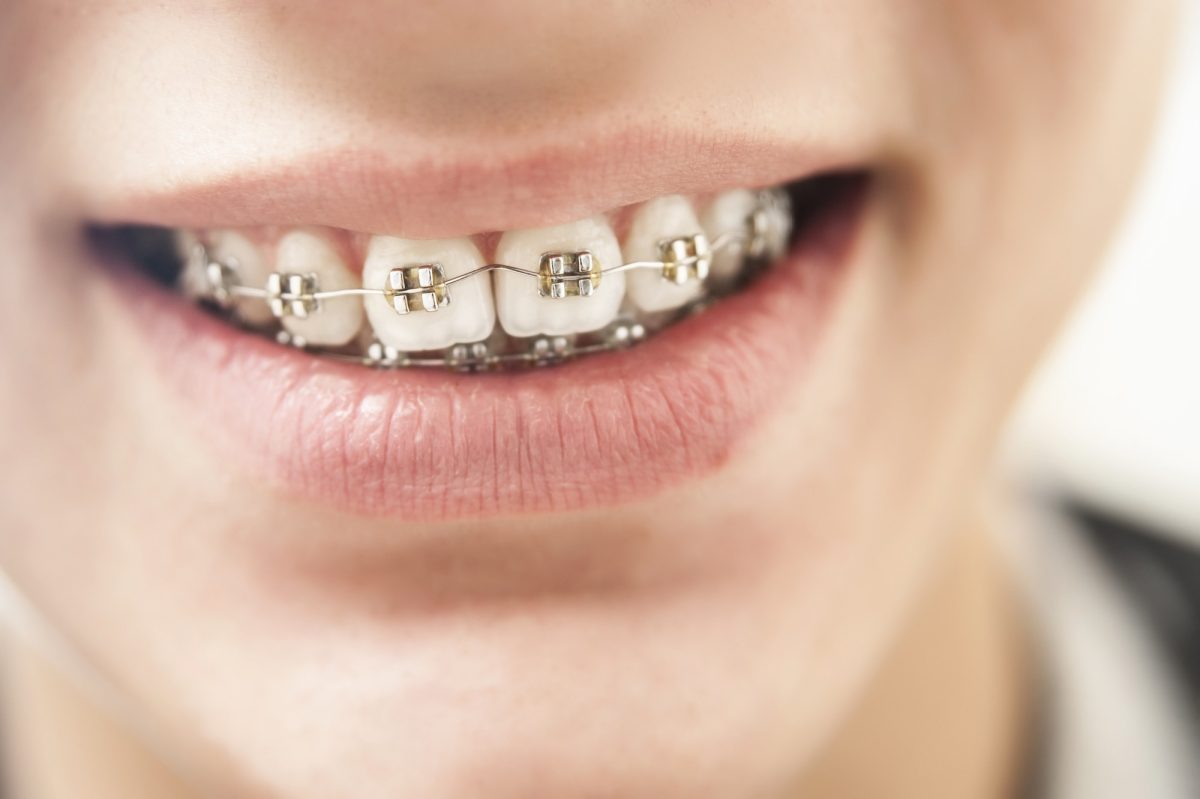 4 Signs Your Child Is Ready for Braces
